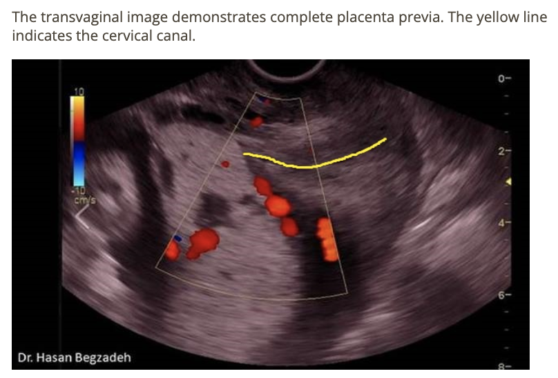 <p>d) complete placenta previa</p>