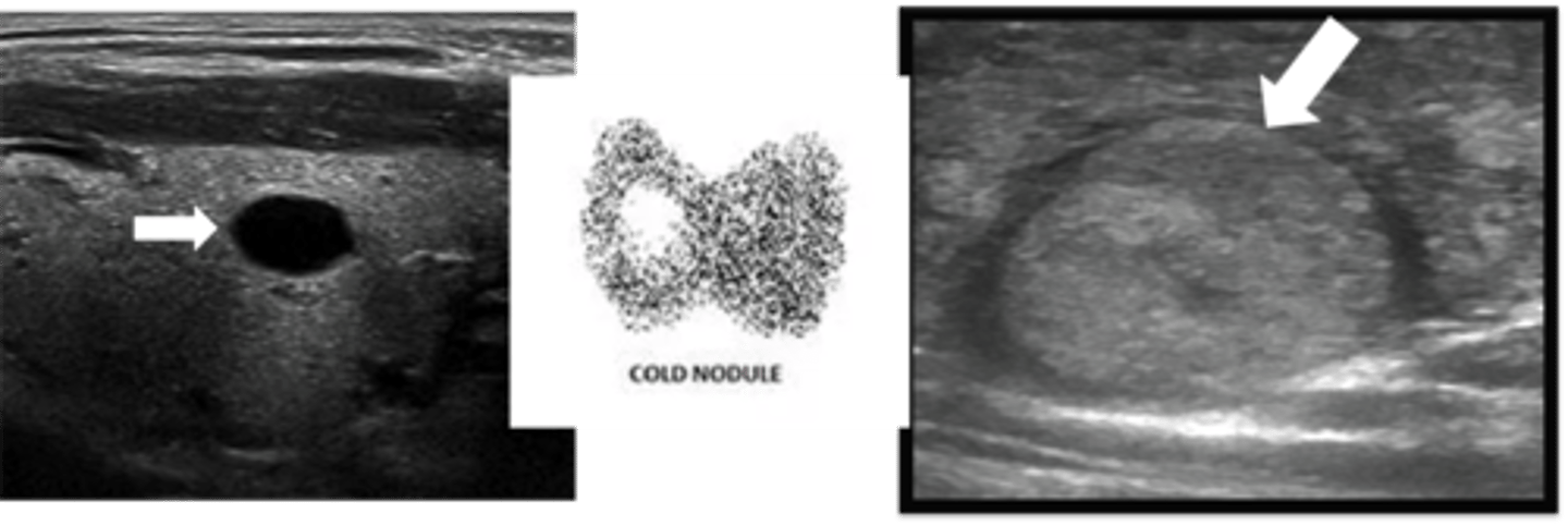 <p>Define Condition:</p><p>Abnormal growth of thyroid cells --&gt; lump in thyroid gland</p><p>-Hx: Extremely common</p><p>-PE: Asymm enlargement of Thyroid Gland</p><p>-Dx:</p><p>Labs</p><p>&gt; TSH = Normal to High</p><p>Imaging</p><p>&gt; Incidental Finding</p><p>&gt; Radioiodine = COLD (low)</p><p>&gt; Thyroid US = Nothing or Worrisome --&gt; Fine Needle Aspiration = Reassuring (CYSTIC, SMOOTH MARGINS)</p><p>-Tx: OBSERVE</p>