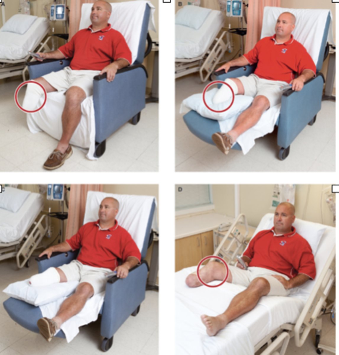 <p>(A) Improper sitting position following a transtibial amputation. Although this position may initially feel comfortable, the residual limb is in a dependent position, which promotes swelling, and the knee is flexed (see red circle), which promotes knee flexion contracture.</p><p>(B) Here the residual limb is supported, but notice that the knee is still flexed, creating pressure on the distal end of the residual limb that could lead to pressure injuries.</p><p>(C) Preferred sitting position is with the residual limb completely supported and the knee resting in extension.</p><p>(D) This position of the bed may be comfortable, but over time, it increases the risk of the development of a knee flexion contracture.</p><p>(E) Here the bed position has been modified so that the patient's right knee is extended, reducing contracture risk.</p>