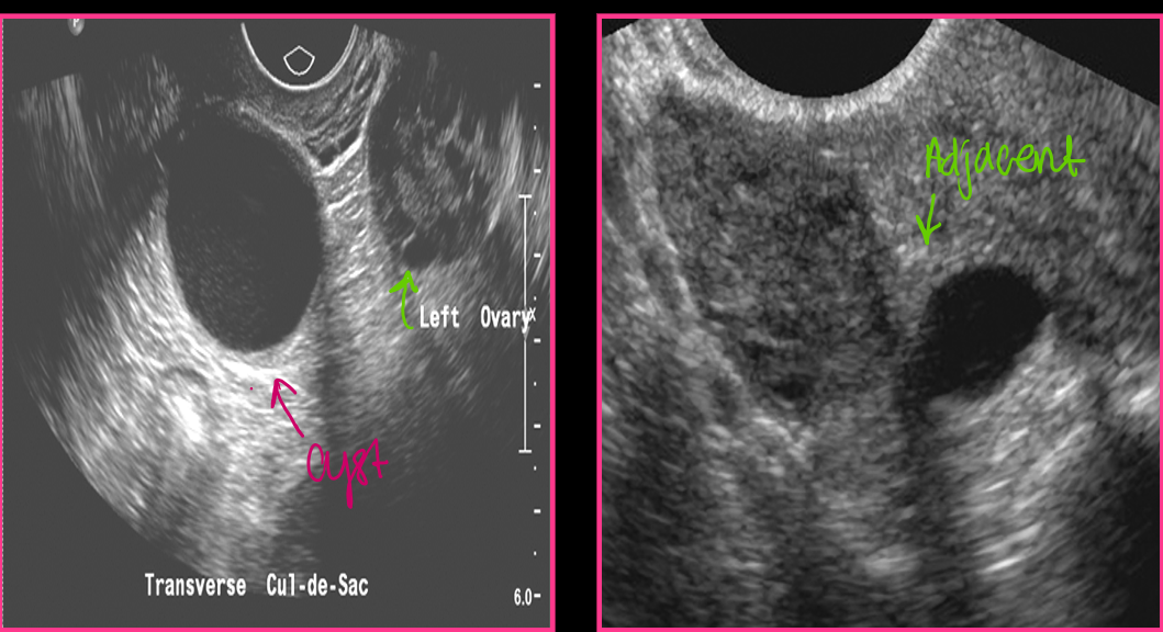 <p>Paraovarian cysts account for approximately _____ of all adnexal masses </p>