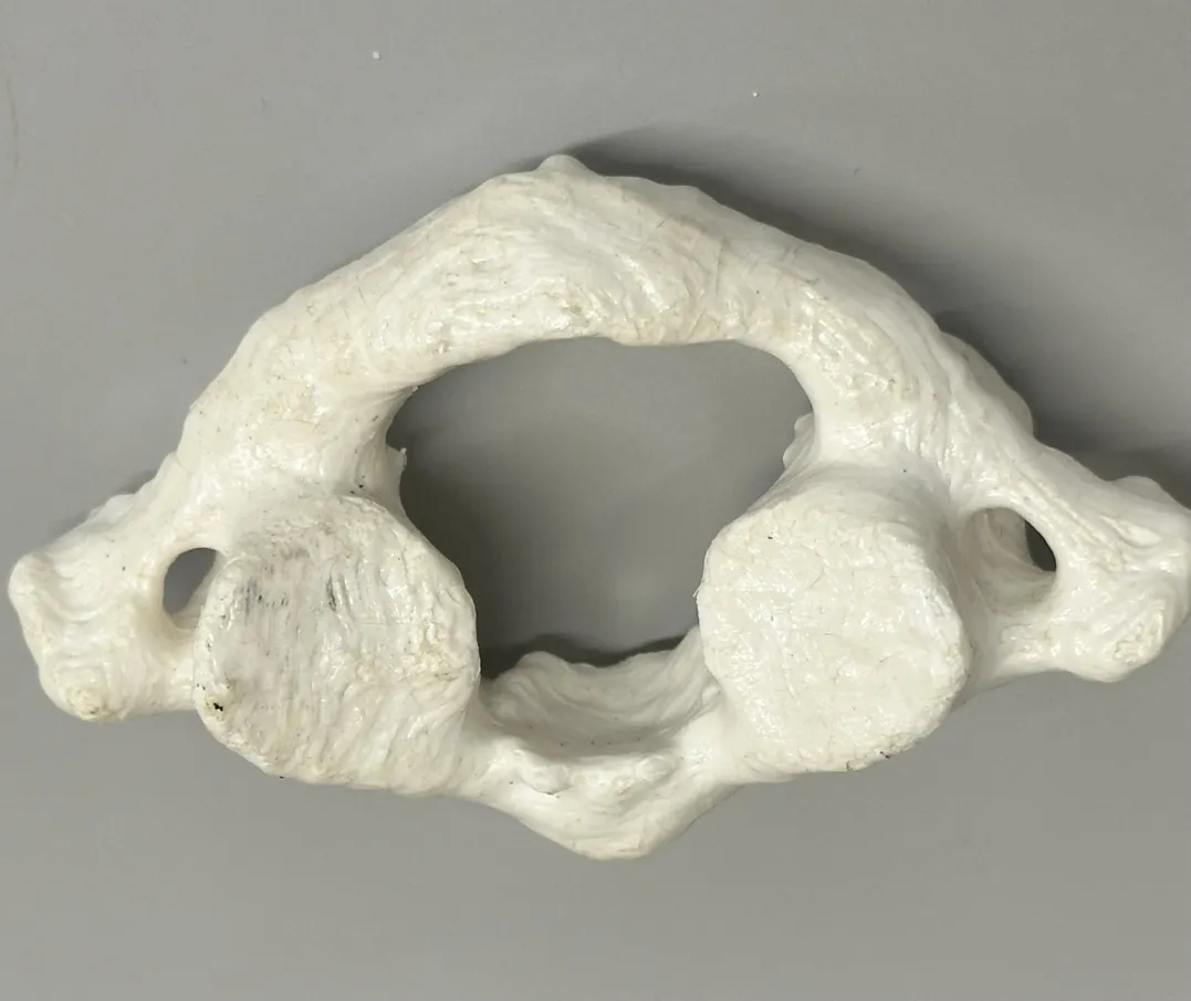 <p>C1</p><p>has NO:</p><ul><li><p>body</p></li><li><p>lamina</p></li><li><p>pedicle</p></li><li><p>spinous process</p></li></ul><p></p>