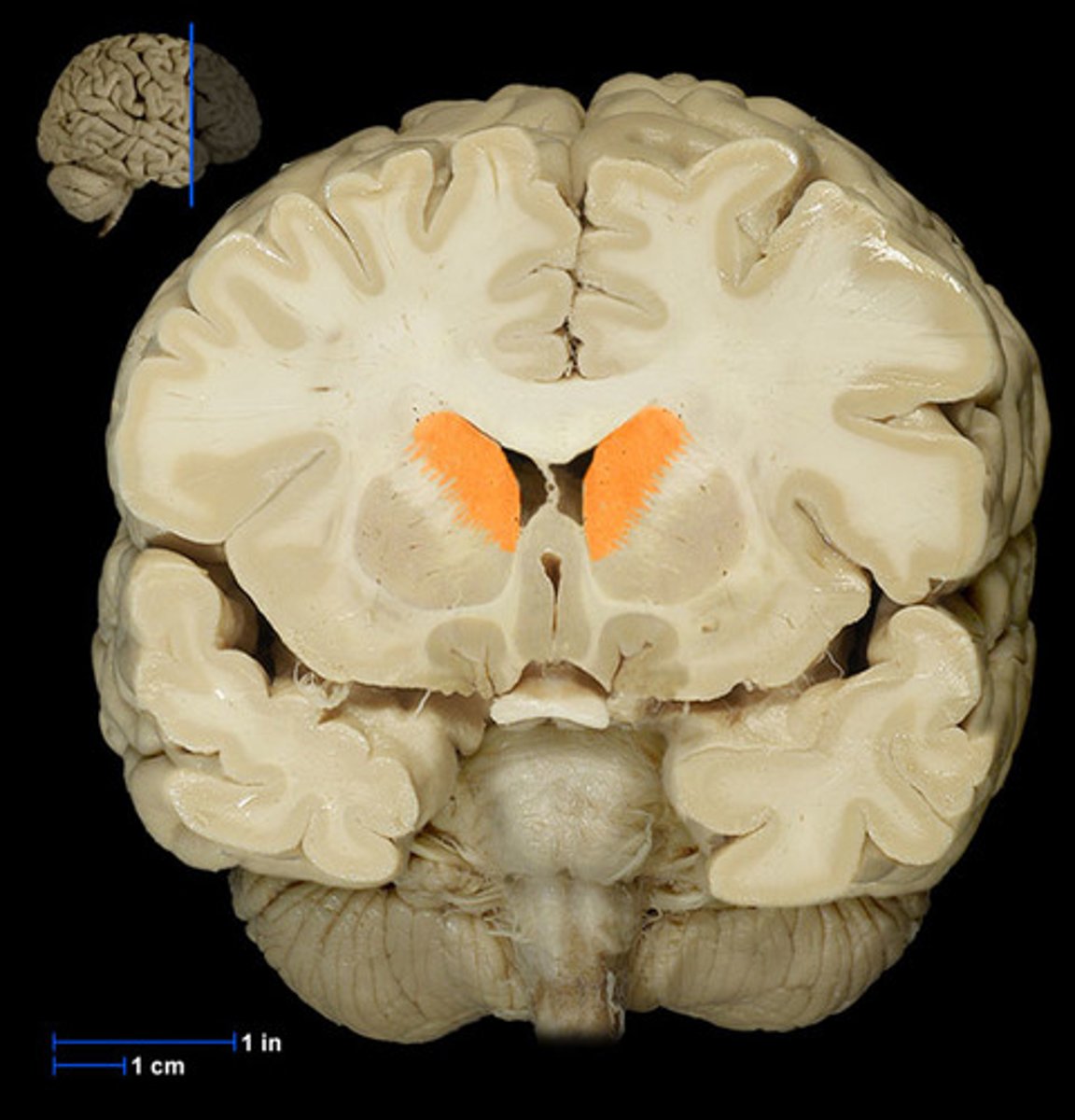 <p>One of the major nuclei that make up the basal ganglia. Head: Anterior to the thalamus, forming the lateral wall of the lateral ventricle.</p><p>Body: Extends posteriorly and laterally from the head, parallel to the thalamus.</p><p>Tail: Curves inferiorly and medially, lying above the temporal horn of the lateral ventricle.</p>