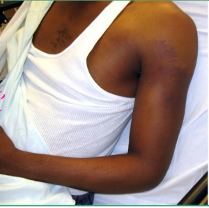 <p><strong>Posterior Shoulder Dislocation</strong> (Rare)</p><p>-Mechanism of Injury </p><ul><li><p>Blow to ________ shoulder </p></li><li><p>Axial load of an ___________ and internally rotated arm</p></li><li><p>Violent muscle contractions → ________ or _______ shock </p></li></ul><p>-S/S</p><ul><li><p>Prominence of ________ shoulder with anterior _________</p></li><li><p>Prominent coracoid</p></li><li><p>Adducted and internally rotated arm</p></li><li><p>________ to externally rotate </p></li></ul><p>-Diagnosis → _-___</p><ul><li><p>Light bulb sign</p></li></ul><p></p>