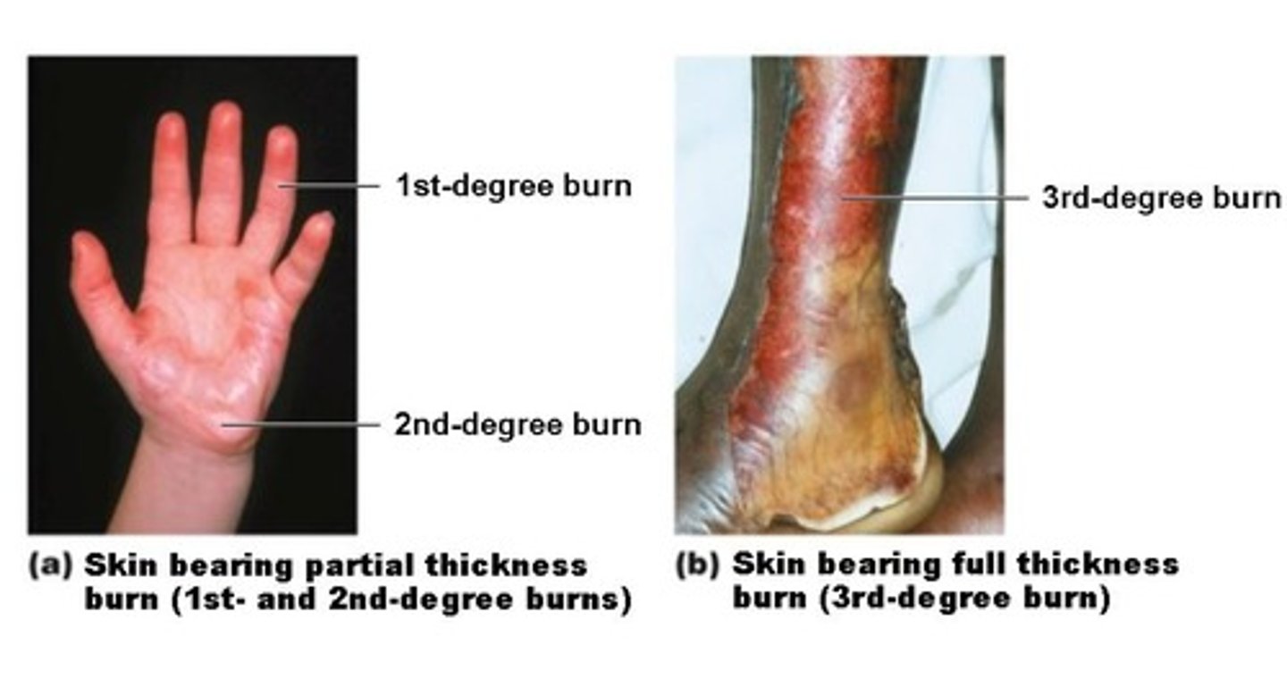 <p>1st degree</p><p>2nd degree</p><p>3rd degree</p>
