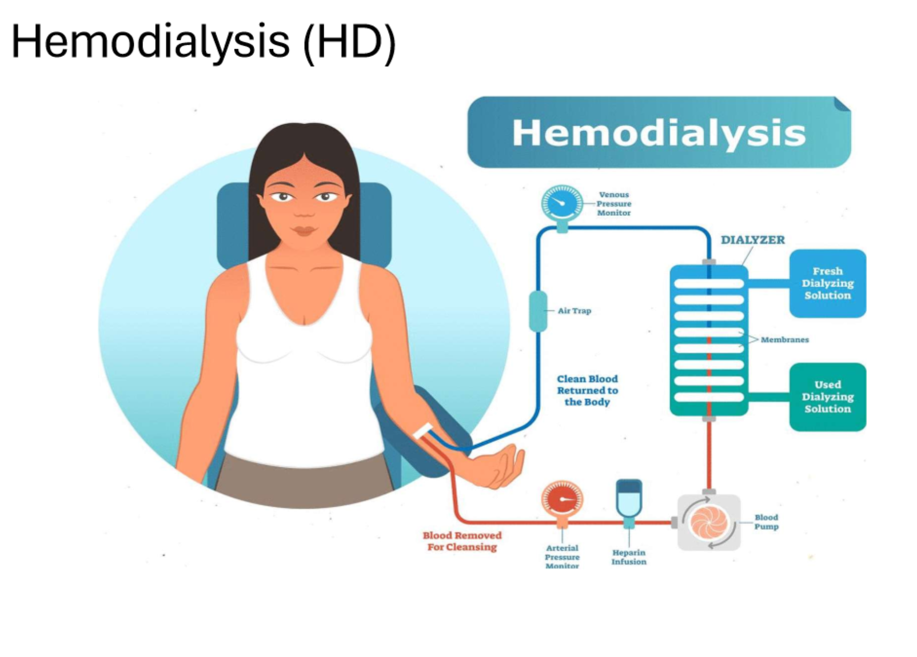 <p>What does 'hemodialysis' involve?</p>
