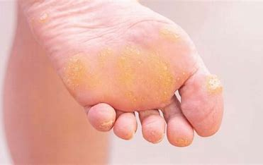 <p>an overgrowth of epidermis from excessive pressure from the friction of work &amp; weight bearing (overuse of skin)</p>