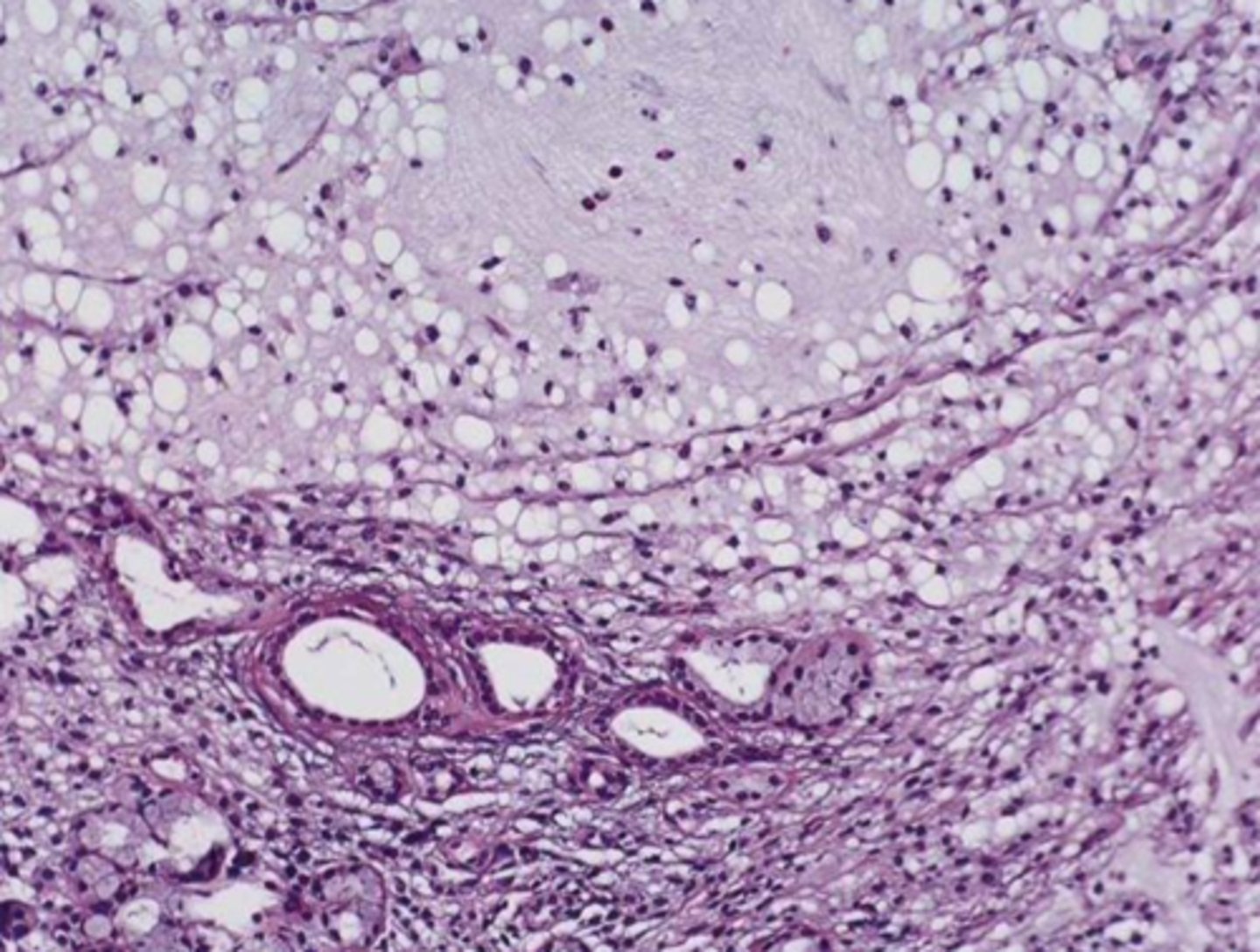 <p>• Granulation tissue</p><p>• Spilled mucin</p><p>• Inflamed salivary gland tissue</p>