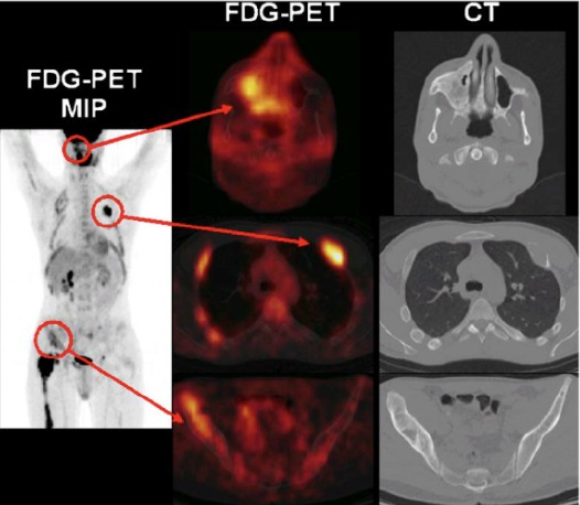 <ul><li><p><strong>Biopsi</strong>: Viktigast för mikroskopi.</p><ul><li><p>Immunohistokemi</p></li><li><p>Flödescytometri</p></li><li><p>Ljusmikroskop (histologi)</p></li></ul></li><li><p><strong>PET-CT</strong>: Positronemissionstomografi. Här används radioaktivt druvsocker, FDG, som tumörceller använder för sin metabolism. Används för att se metastaser.</p></li><li><p><strong>Lymfadenopati</strong></p></li><li><p><strong>DT</strong></p></li><li><p><strong>Blodstatus</strong></p></li></ul>