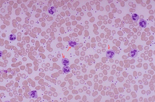 <ol><li><p>Identify pointed structures</p></li><li><p>In a complete CBC, what is the simplest indicator of acute inflammation?</p></li></ol>