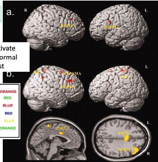 <p>Antidepressants help → reducing Serotonin autoreceptor sensitivity<br>Antipsychotics and glutamate blocks help other patients.<br>OCD patients activate DLPFC more than normal during Stroop test</p><ul><li><p>Overthinking.</p></li></ul><p></p><p>OCD patients have increased activity in orbital frontal cortex and caudate nuclei (basal ganglia)</p><p>Surgery to disconnect Orbitofrontal cortex from anterior cingulate cortex produces long lasting improvement.</p><p></p>