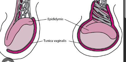 <p>= sudden twisting of the spermatic cord that requires emergency surgery</p><ul><li><p>S: excruciating unilateral pain in testicle</p></li><li><p>O: red, swollen scrotum; one testis higher than the other</p></li></ul>