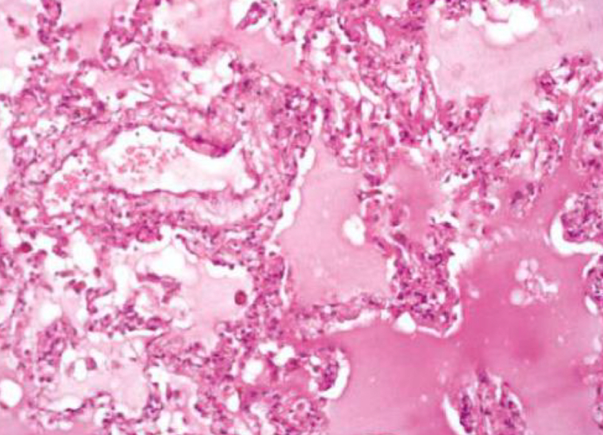 <p>what condition is depicted</p>