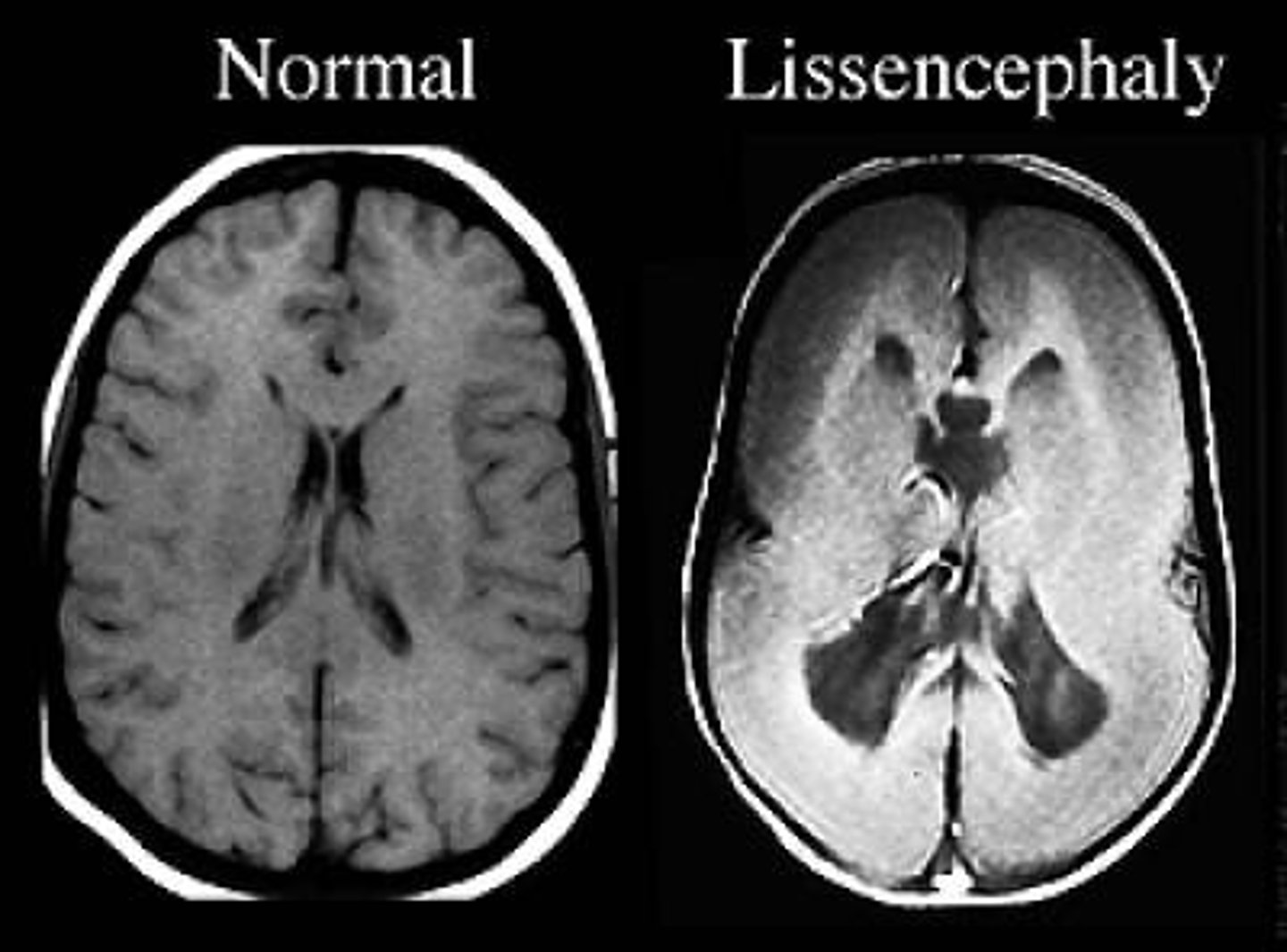 <p>Define Lissencephaly</p>
