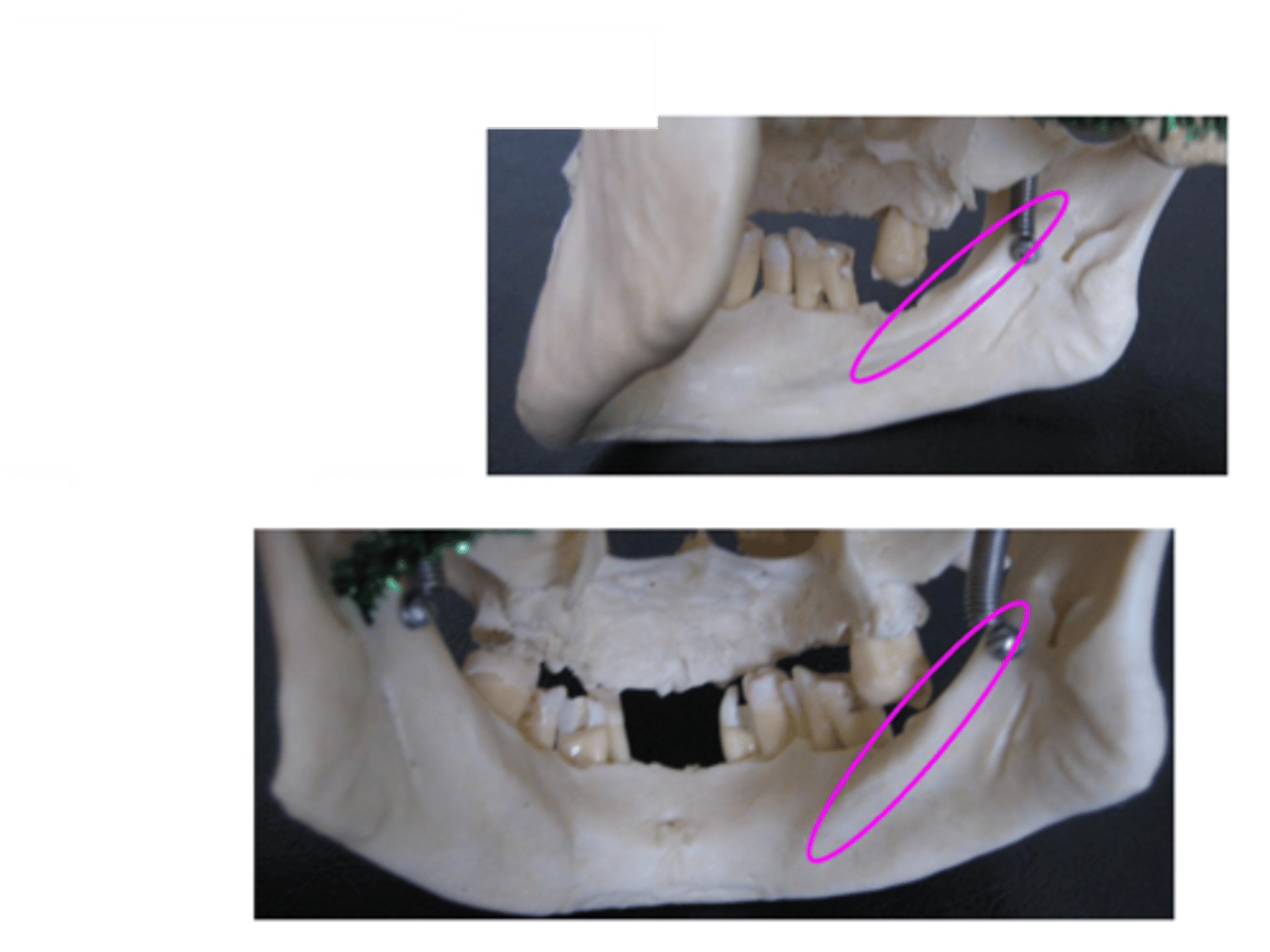 <p>Attachment for mylohyloid muscle, separates sublingual/submandibular fossae</p>