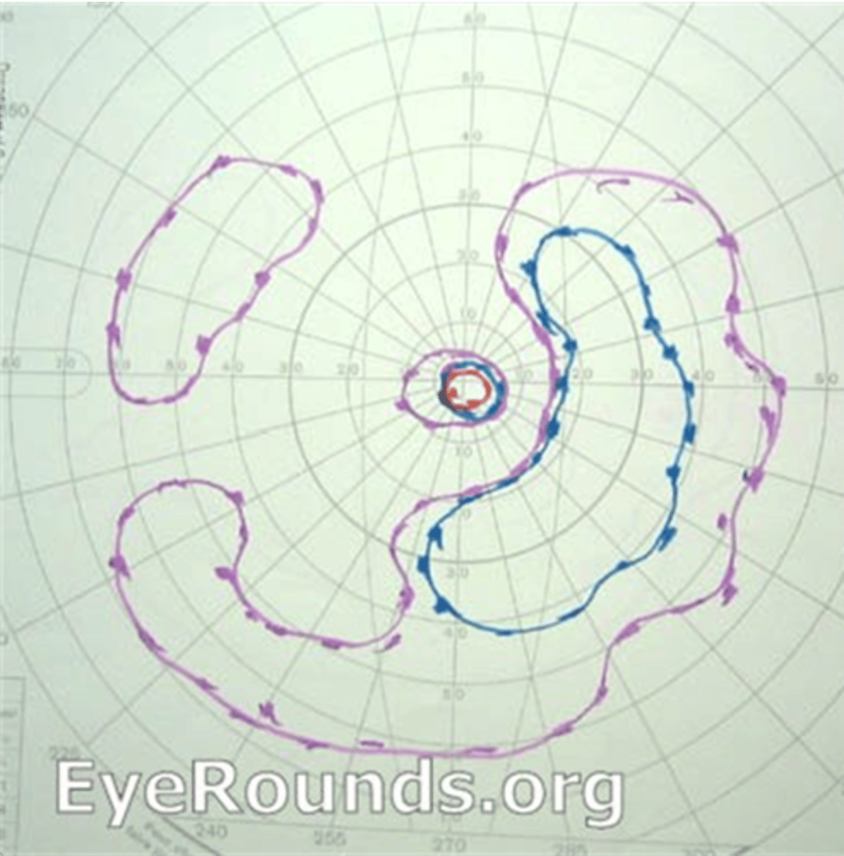 <p>isolated scotomas around 20deg from fixation = coalesce into a ring scotoma in midperiphery = expands quickly into far periphery, slowly into central fixation</p>