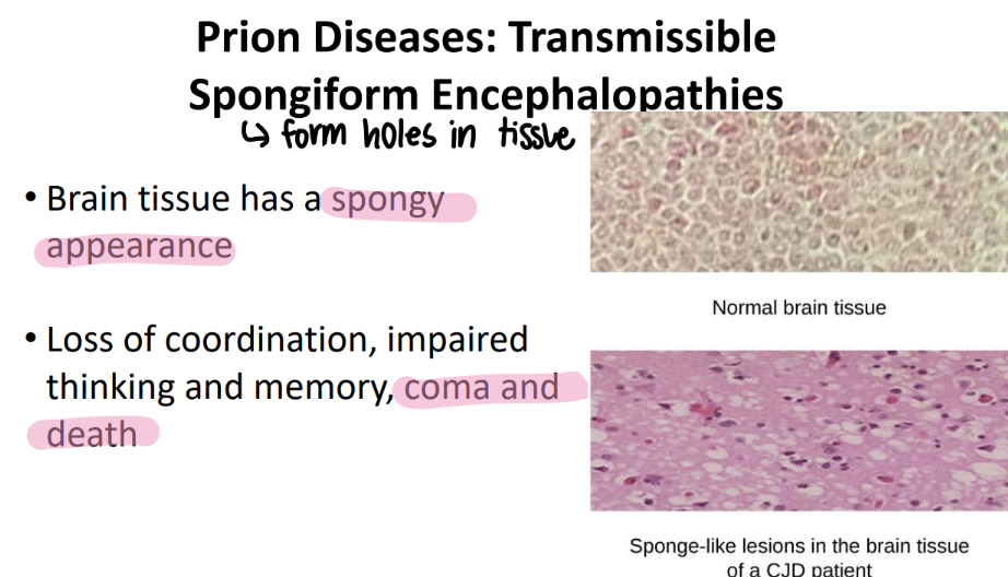 <p>the prion clumps make HOLES in brain tissue </p><ul><li><p>lose coordination, bad memory, coma, death </p></li></ul>