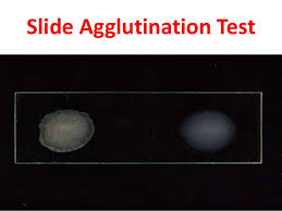 <p>Slide agglutination test was performed using the serum of two patients, patient A and patient B, to detect antigen for Salmonella, </p>