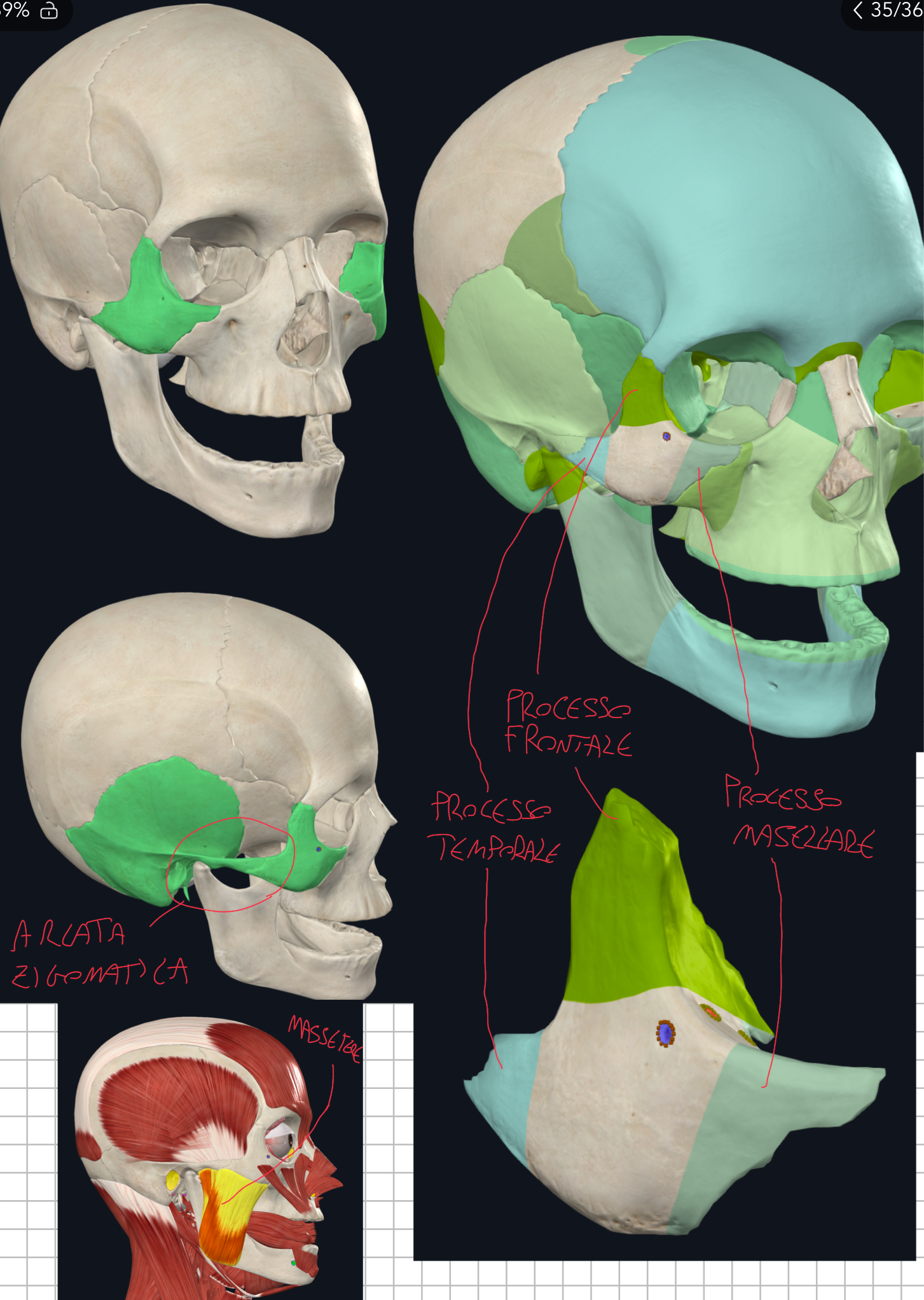 <p>Generalità:</p><ul><li><p>E’ l’osso della guancia </p></li><li><p>Forma quadrangolare a “diamante”</p></li><li><p>Collega il viscerocranio (massiccio facciale) al neurocranio</p></li></ul><p>Facce:</p><ul><li><p>Faccia Laterale (o malare) → convessa e ben visibile all’esterno, dove forma la prominenza dello zigomo</p></li><li><p>Faccia Mediale (o temporale) → rivolta verso le fosse extracraniche → sia fossa temporale che infratemporale.</p></li></ul><p>Processi:</p><ul><li><p>Processo Frontale → in alto → si articola con il processo zigomatico del frontale → è robusto e importante per la dispersione delle forze masticatorie</p></li><li><p>Processo Temporale → lateroposteriormente → breve e si articola con il processo zigomatico del temporale → insieme formano l’Arcata Zigomatica</p></li><li><p>Processo Mascellare → anteromedialmente → si articola con il processo zigomatico del mascellare</p></li></ul><p>Arcata Zigomatica:</p><ul><li><p>Formata dall’unione del processo temporale dello zigomatico + processo zigomatico del temporale</p></li><li><p>Costituisce punto d’attacco fondamentale per i muscoli masticatori (soprattutto il massetere)</p></li></ul><p></p>
