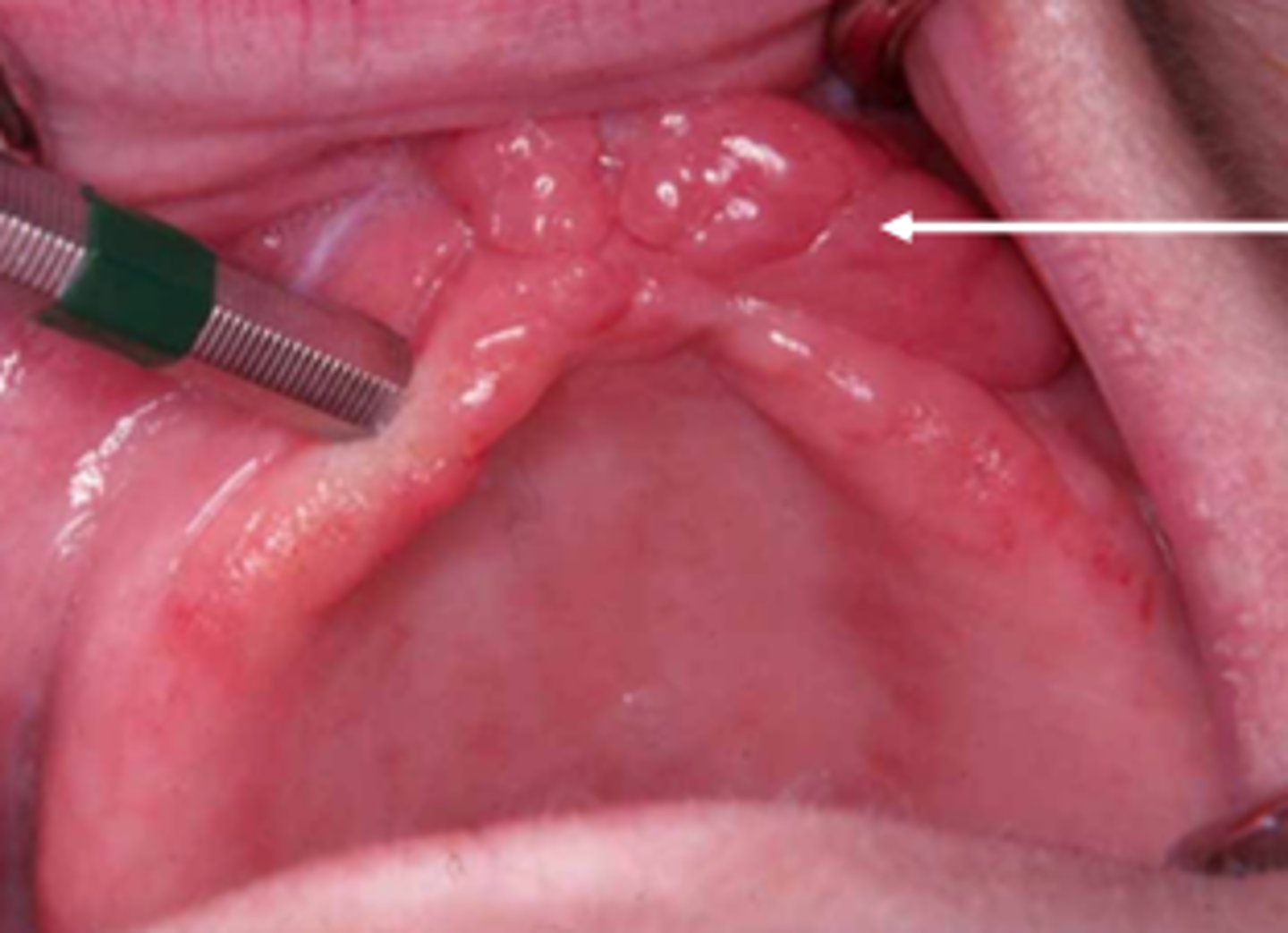 <p>ill fitting denture</p>