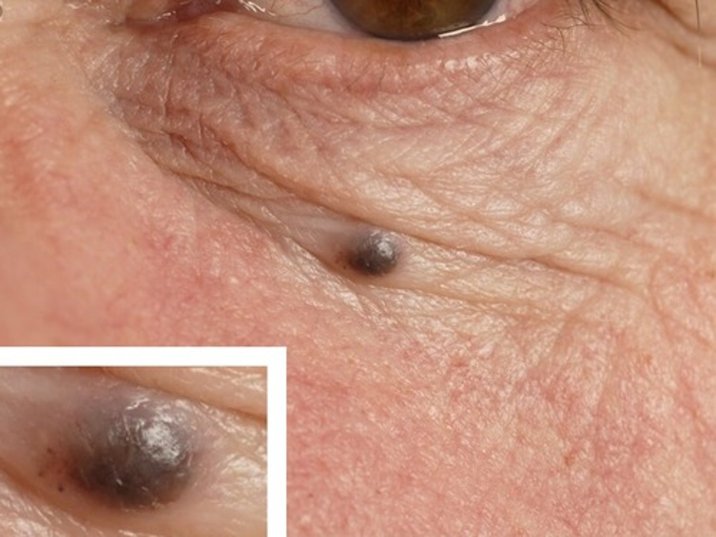 <p>Hoe heet dit klinisch beeld?</p>
