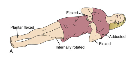 <p>Flexion of arm, wrists, and fingers with adduction in the upper extremity and extension, internal rotation, and plantar flexion of lower extremity.</p>