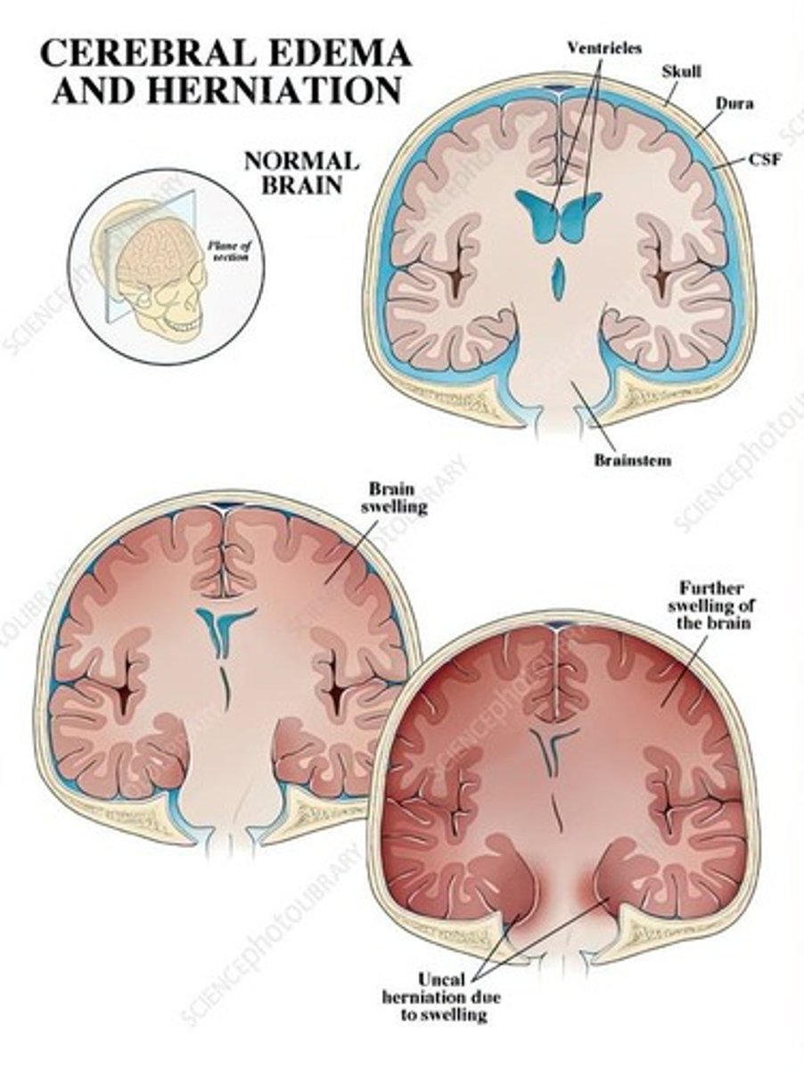 <p>Condition following head injuries or infections.</p>