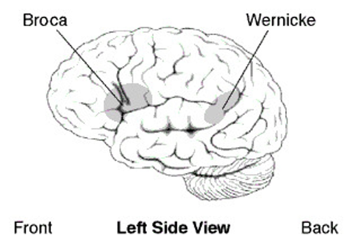<p>Broca's aphasia will exhibit broken speech, but comprehension is preserved.</p><p>Wernicke's aphasia (fluent aphasia) will exhibit fluent speech, but loss of meaning, almost like a word salad.</p><p>Conductive aphasia exhibits having a tough time expressing the correct thoughts from Wernicke's area to Broca's Area, but with enough time patients will correctly get their point across.</p>
