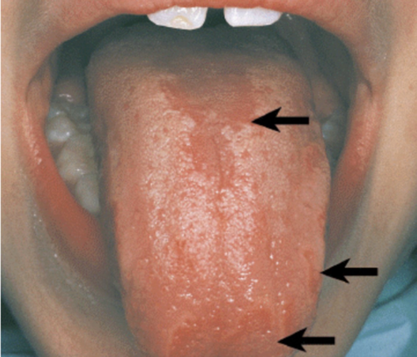 <p>Median rhomboid glossitis</p>