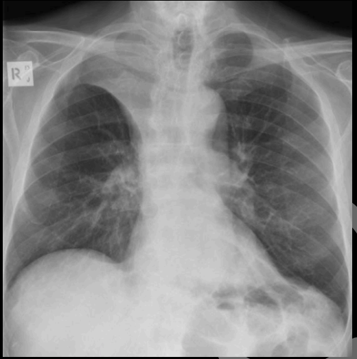 <p>Colapso pulmonar del lóbulo superior derecho</p>