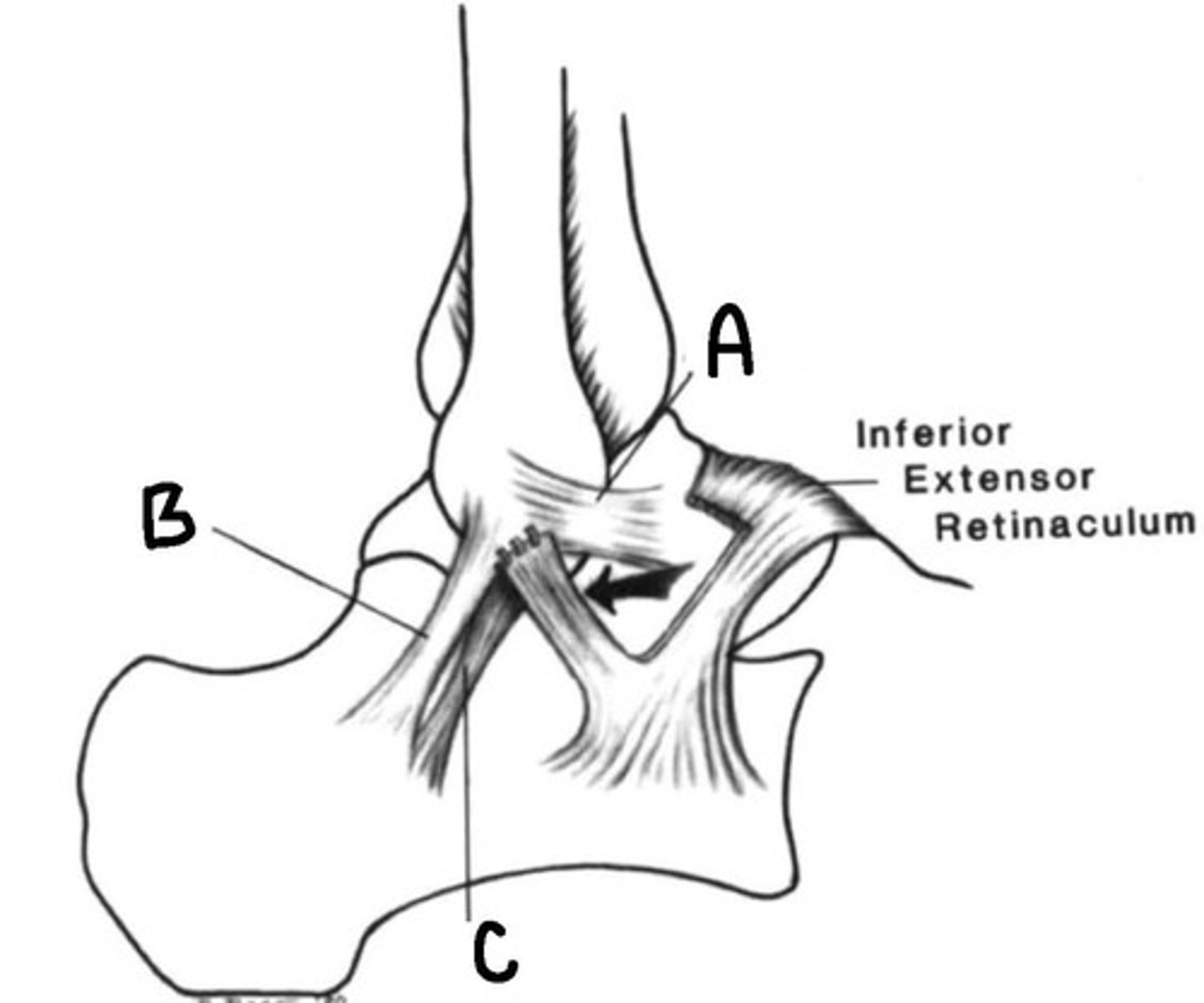 <p>Ligaments in an ankle sprain</p>