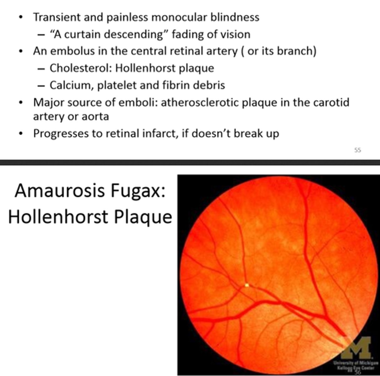<p>painless temporary loss of vision in one or both eyes</p>