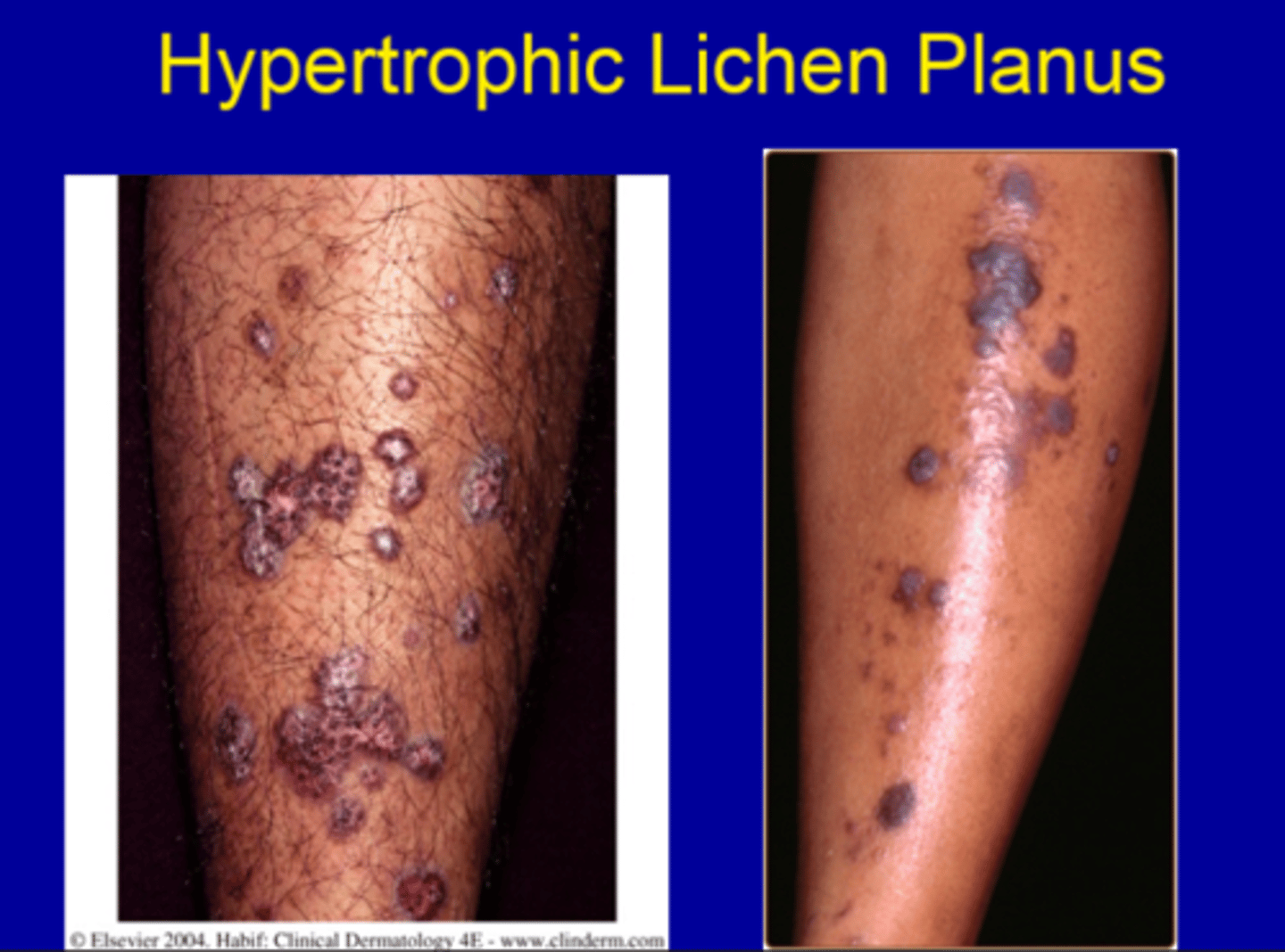 <p>Hypertrophic lichen planus</p>