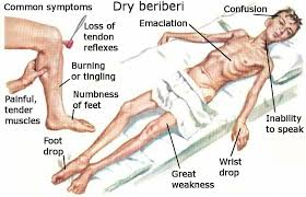 <p>Beri-beri (Loss of feeling (sensation) in hands and feet.)<br></p>