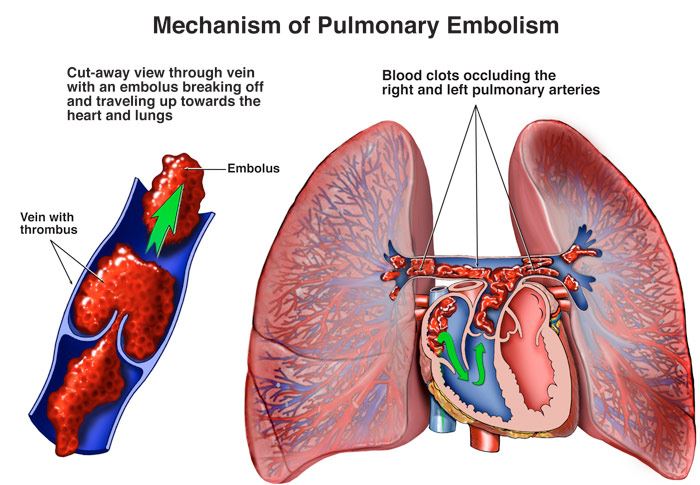 <p>One or more <strong><u>branches of the pulmonary artery</u></strong></p>