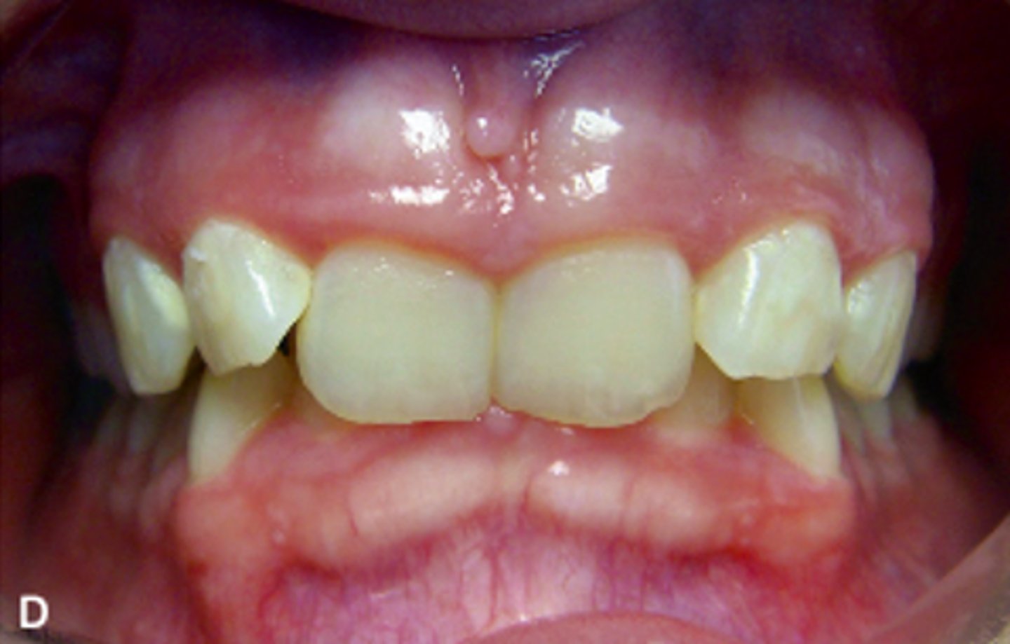 <p>ID the occlusion classification:</p>