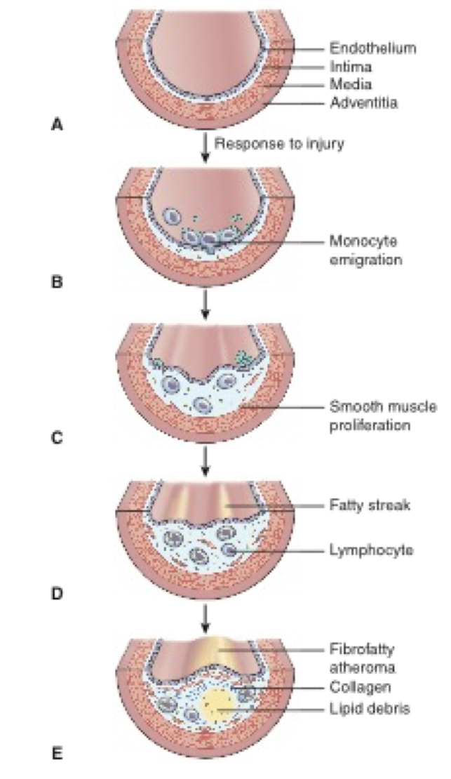 <ul><li><p>Atherosclerosis begins as monocytes and lipids enter the intima of an injured vessel.</p></li><li><p>Smooth muscle cells proliferate within the vessel wall</p></li><li><p>Contributing to the development of fatty accumulations and atheroma</p></li><li><p>As the plaque enlarges, the vessel narrows and blood flow decreases</p></li><li><p>The plaque may rupture and a thrombus might form, obstructing blood flow.</p></li></ul><p></p>