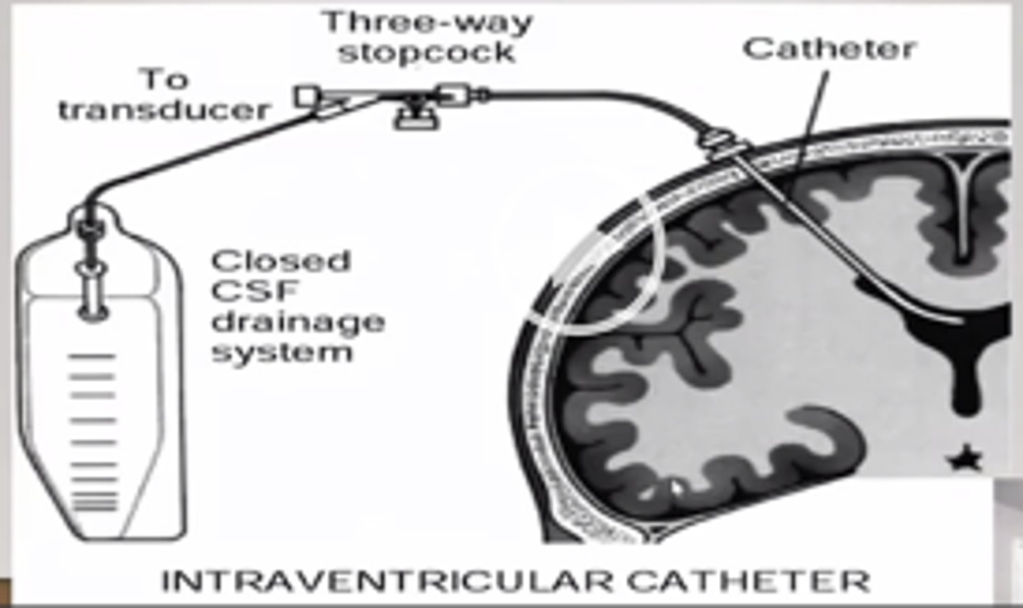 <p>Gold standard of ICP monitoring; burr hole in skull allows entry into lateral ventricle on nondominant side; provides means for recalibration when measurement drift occurs</p>