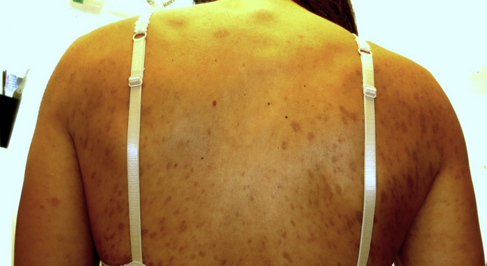 <p>pregnant pt w/ no prenatal care presents with maculopapular rash involving trunk, extremities, palms/soles</p>