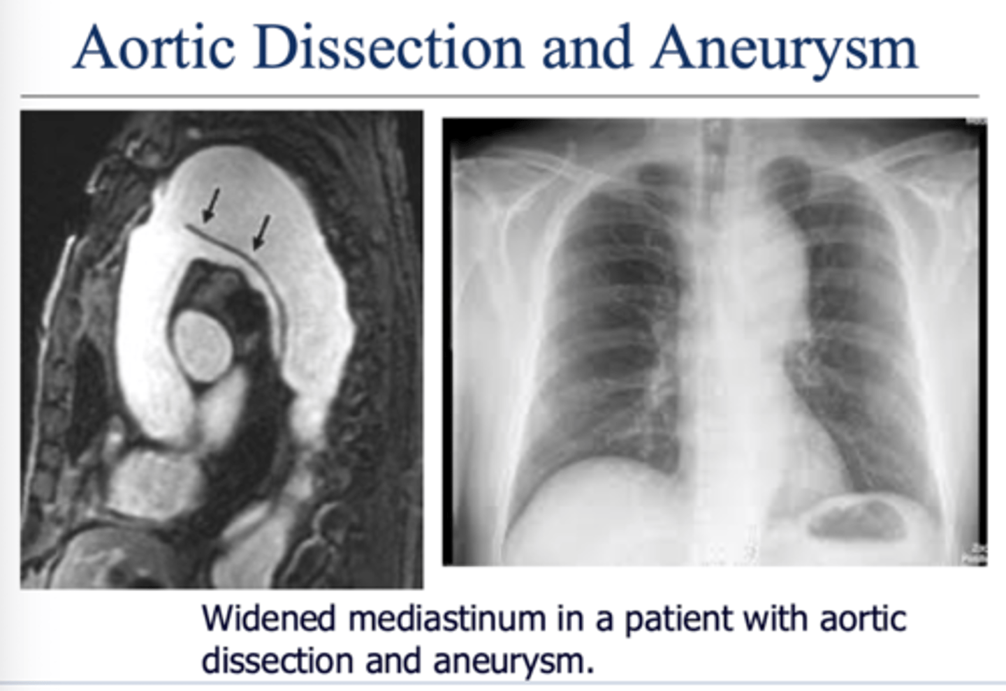 <p>Dilation of the aorta with or without dissection of the aortic wall.</p><p>Widening of aorta greater than 5 cm is at risk for rupture</p><p>CT scan with contrast</p>