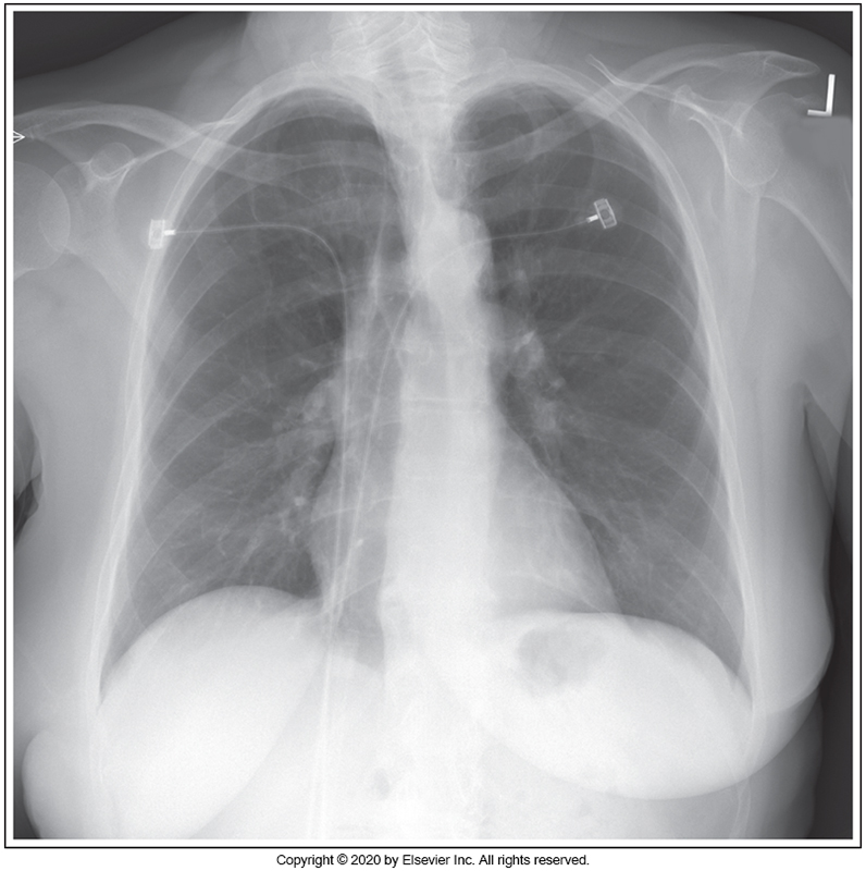 <p>Identify the main problem of the image below (PA chest)</p><p>Patient is in an RAO position</p><p></p><p>Patient is in an LAO position</p><p>&nbsp;</p><p>Patient upper thorax is tilted anteriorly.</p><p>&nbsp;</p><p>Patient's upper thorax is tilted posteriorly.</p>