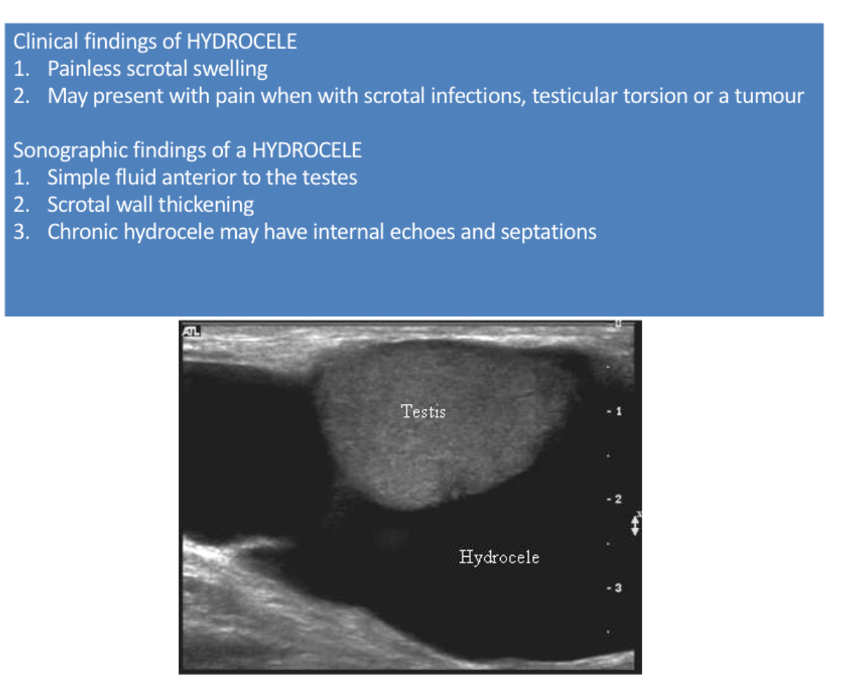 <p>What is the <strong>most common cause of painless scrotal swelling</strong>?</p>