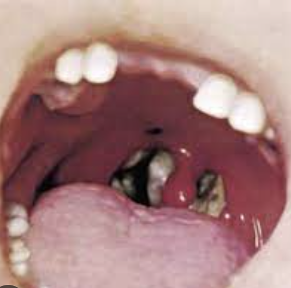 <ul><li><p>Diphtheria Antitoxin <span data-name="lips" data-type="emoji">👄</span></p></li></ul><p></p>