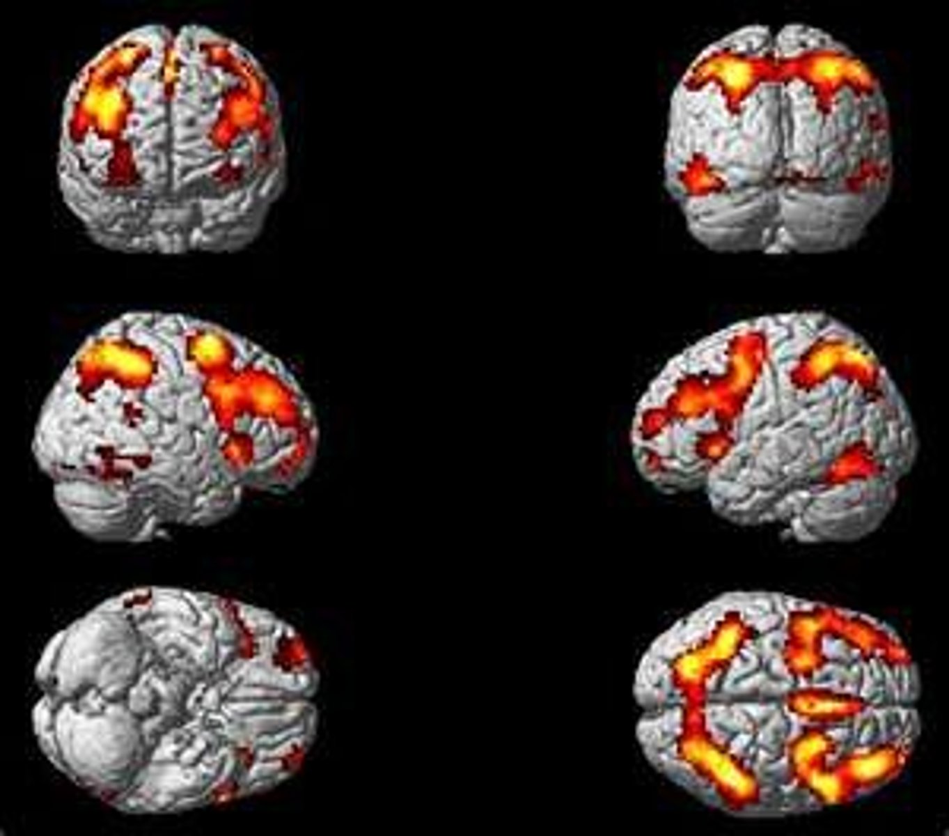 <p>A technique for revealing blood flow and, therefore, brain activity by comparing successive MRI scans.</p>