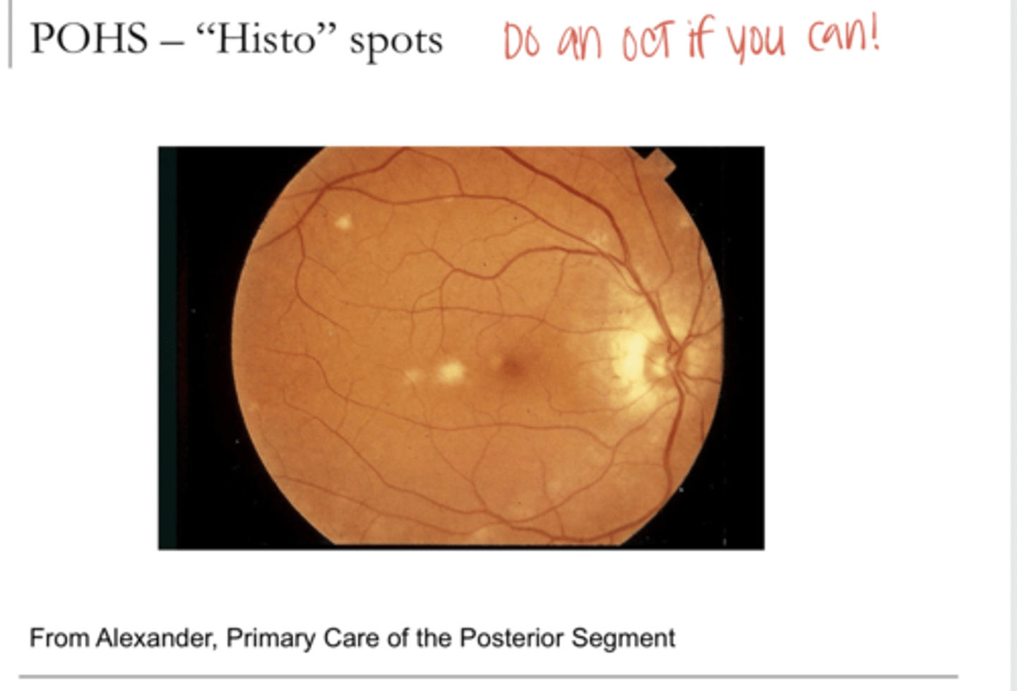 <p>Presumed Ocular Histoplasmosis Syndrome (POHS) -- Histo Spots (Pic)</p>