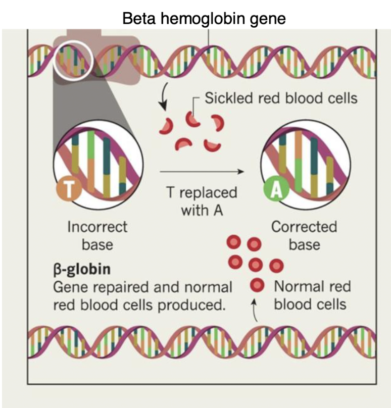 
1. remove blood stem cells from the body 
2. use CRISPR to correct the DNA mutation for sickle cell in the nucleus 

   
   1. the incorrect DNA code has a “T” at a specific location in the β globin gene
   2. CRISPR can precisely edit the gene to correct this DNA nucleotide to an “A” 
3. return the stem cells to the bone marrow where these cells produce normal β globin subunits

\
\*NOTE: this can CURE sickle cell disease 