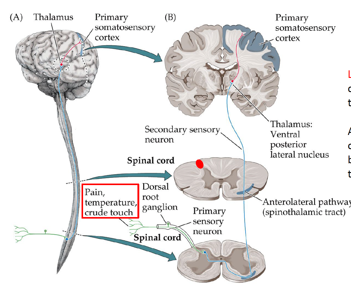 <p>main somatosensory pathway</p><p>contralateral</p><p>crosses at the spinal cord</p><p>pain, temperature, crude touch</p><p>( <u>primary sensory neuron )</u> : sensory sent to dorsal root ganglion spinal cord</p><p>( secondary sensory neuron):spinal cord → crosses at anterior horn of spinal cord → anterolateral pathway (spinothalamic tract - in the spinal cord) → thalamus (VPL)</p><p>(third sensory neuron): thelamus → primary somatosensory cortex</p>