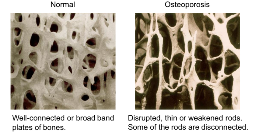 <p>Osteoporosis is a condition where bones become fragile and porous because bone breakdown outpaces bone formation.</p><p>Why does this happen?</p><p>• Hormonal changes (especially drop in estrogen after menopause)</p><p>• Aging</p><p>• Low physical activity</p><p>• Poor diet (low calcium/vitamin D)</p><p>What are the effects?</p><p>• Bones become weaker and easier to fracture</p><p>• Common in the spine, hip, and wrist</p>