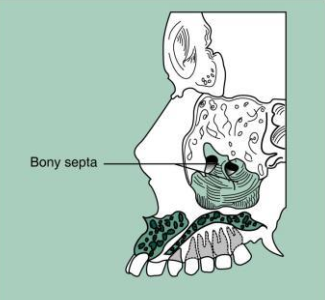 <p>Septa within maxillary sinus </p><ul><li><p>bony wall that appears to divide the maxillary sinus into compartments</p></li><li><p><u>Radiography:</u><strong><u> radiopaque lines</u></strong><u> within the maxillary sinus </u></p></li><li><p><em>**number and presence of septa vary depending on the anatomy of the individual  </em></p></li></ul><p></p>