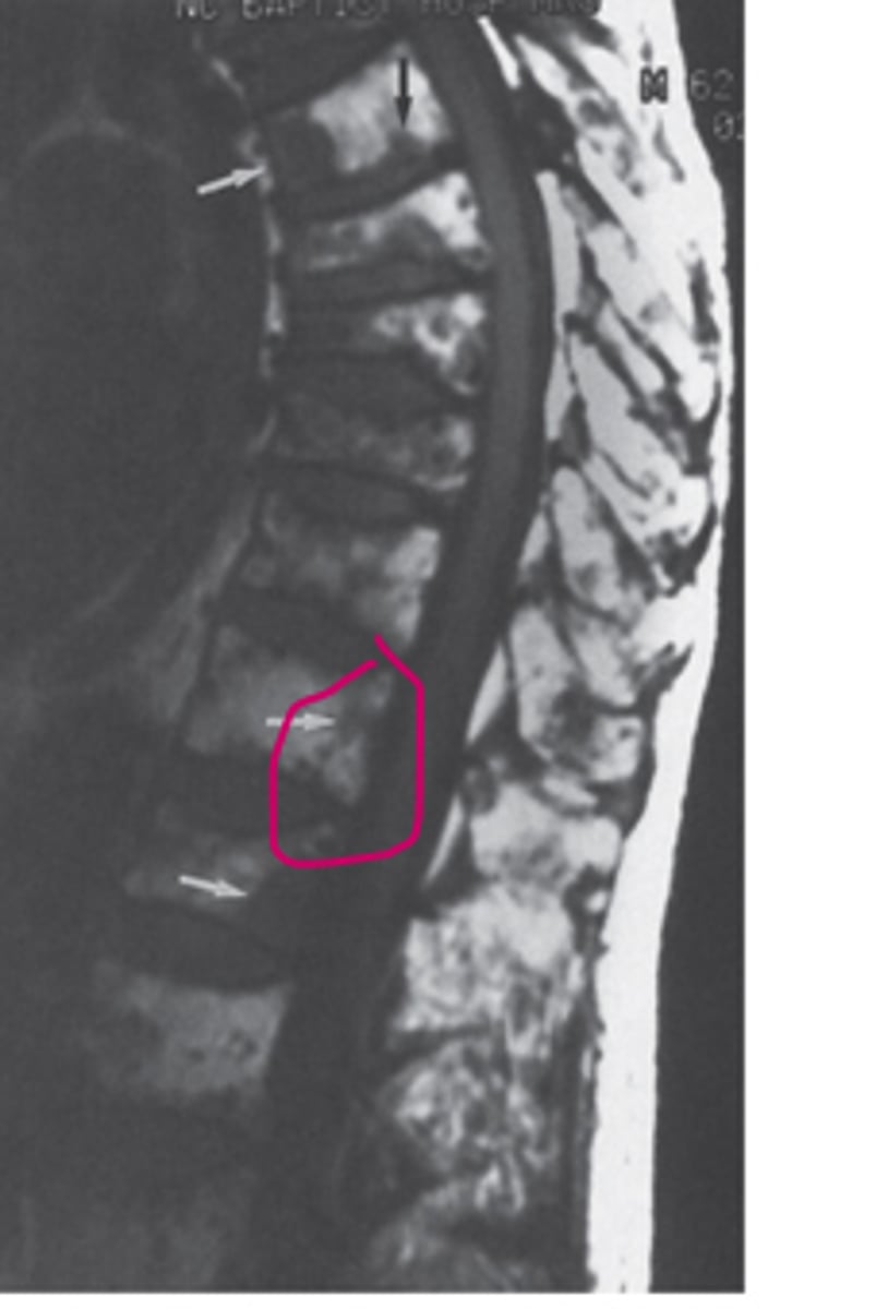 <p>Compression fractures</p>