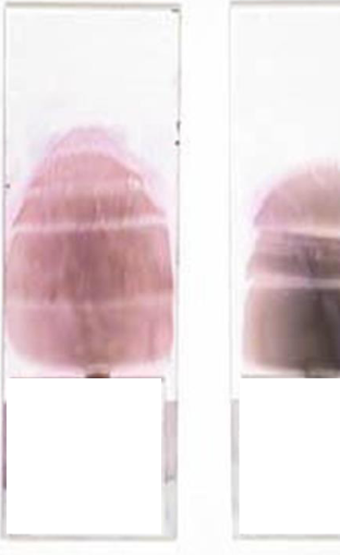 <p>What is this blood film appearance, and what is the cause/solution?</p>